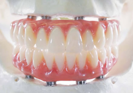 Atlanta GA All-on-4 Dental Implants