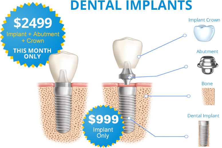 Atlanta GA Dental Implants, Restorations Fulton Tooth Replacement
