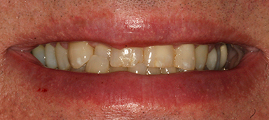 Worn Teeth before and after photo