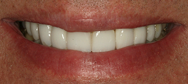 Worn Teeth before and after photo
