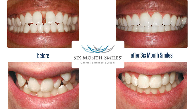 Six monnths smiles before and after photo
