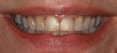 Old Crowns/Veneers before and after photo