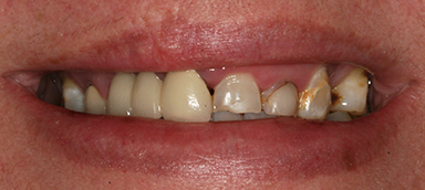 Old Crowns/Veneers before and after photo