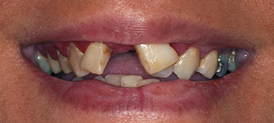 gaps in teeth before and after photo
