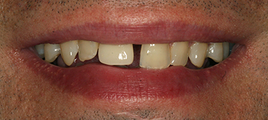 gaps in teeth before and after photo