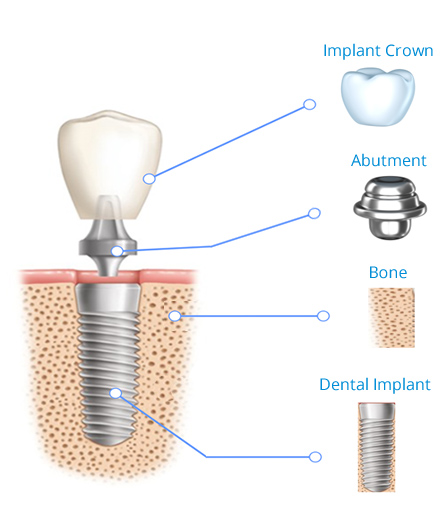Implant structure