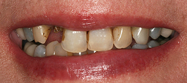 missing teeth before and after photo