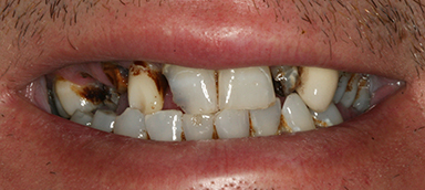 missing teeth before and after photo