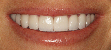 stained teeth after photo
