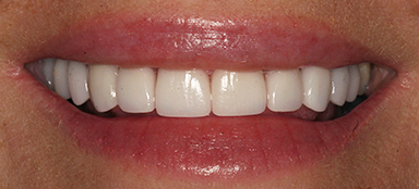stained teeth after photo