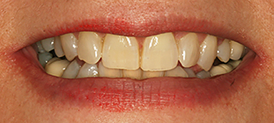 stained teeth before photo