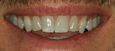 stained teeth before photo