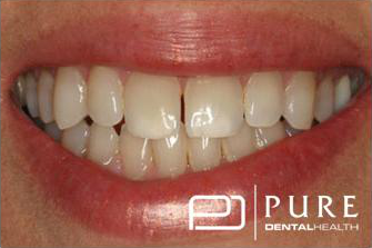 Smile before cosmetic procedures at Pure Dentalhealth buckhead