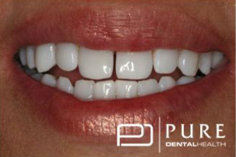 Smile after cosmetic procedures at Pure Dentalhealth buckhead