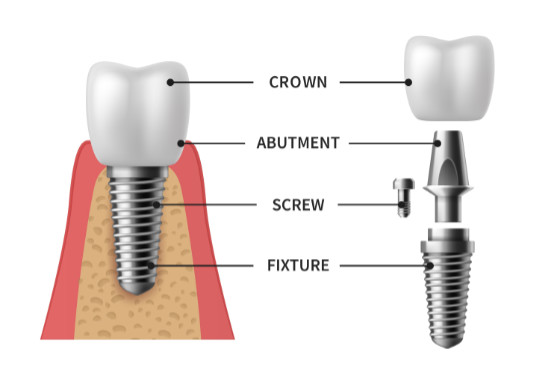 Implant structure. Implant is made of crown, abutment, scew and fixture