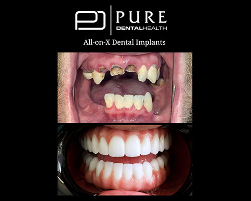 before and after photos of All-on-X dental implants