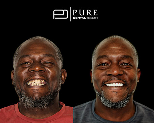 before and after photos of a patient