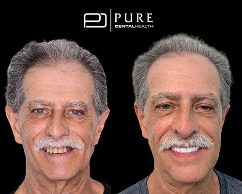 before and after photos of a patient with dental implants