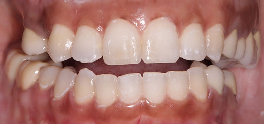 After Invisalign treatment