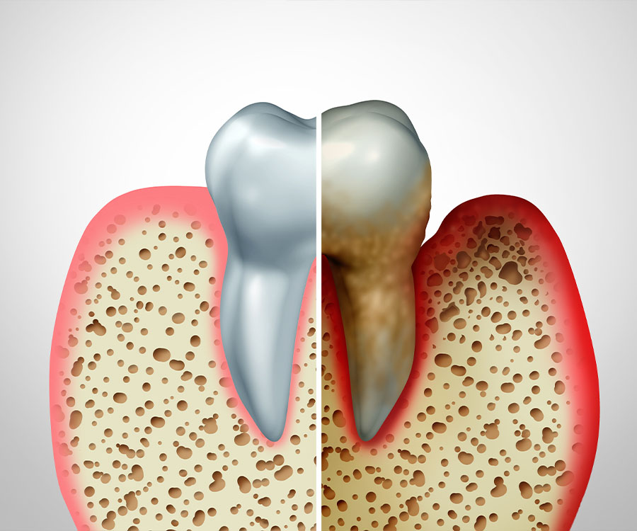 Illustration of a tooth split in half; one side healthy with smooth enamel, the other decayed with visible damage and yellowing.