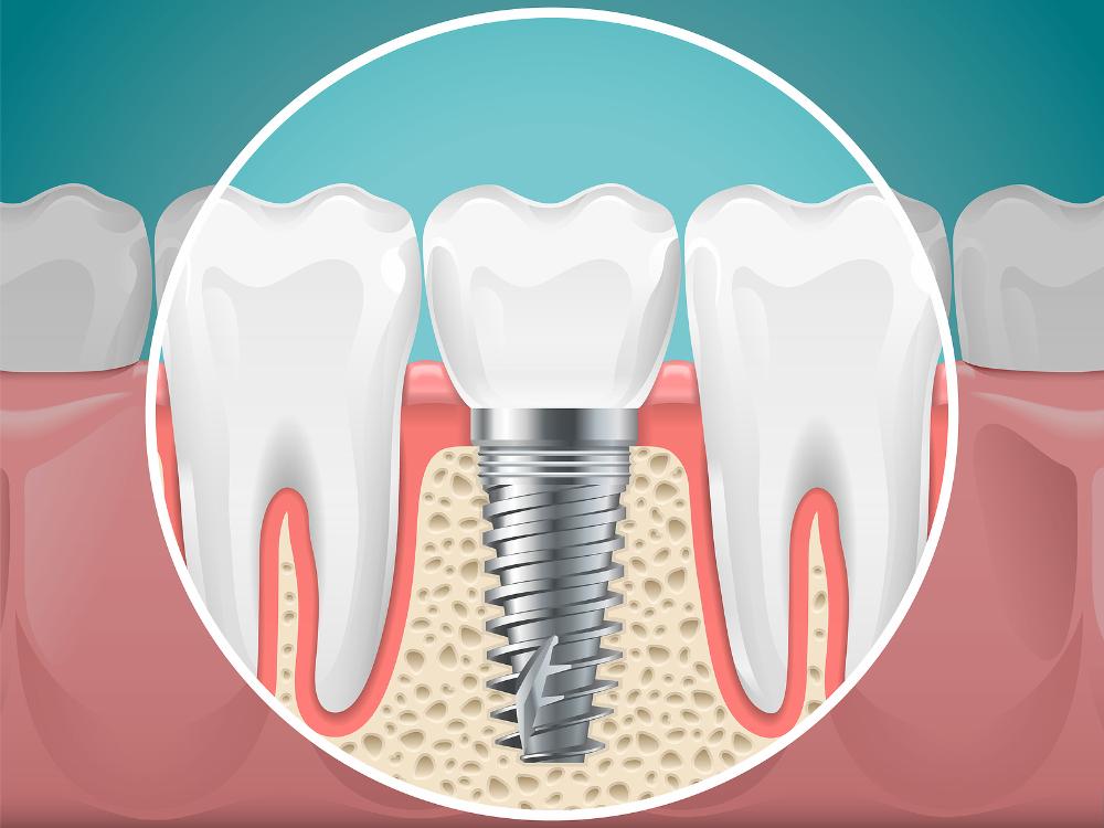 Illustration showing a dental implant embedded in jawbone between two natural teeth, highlighting the implant’s structure and placement.