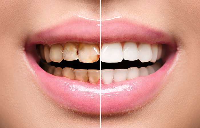 Close-up of a person's mouth showing teeth before and after whitening; left side is stained and discolored, right side is clean and white.