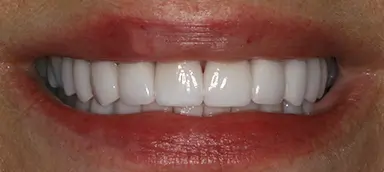 Close-up of a person's mouth showing a set of white, evenly aligned teeth and slightly red lips.