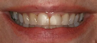 Close-up of a person's mouth showing their teeth and gums, with lips slightly parted in a smile.