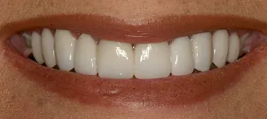 Close-up of a person's mouth showing straight, white teeth and natural lips in a smile.