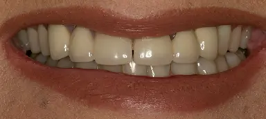 Close-up of a person's mouth, showing clean, straight teeth and natural-colored lips.