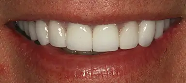 Close-up of a person's mouth showing clean, white, evenly spaced upper and lower teeth with a natural smile.