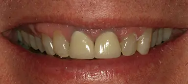 Close-up of a person's mouth showing slightly uneven, yellowed upper teeth and visible gums.