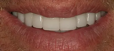 Close-up of a person's mouth with lips slightly parted, showing straight, white teeth.