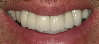 Close-up of a person's mouth showing a set of upper dental implants or prosthetic teeth.