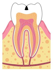 Cross-section illustration of a tooth showing a cavity at the top and the internal structures, including enamel, dentin, pulp, gum, and roots.