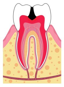 Cross-section diagram of a tooth showing a large cavity reaching the pulp, with visible layers of enamel, dentin, pulp, gum tissue, and surrounding bone.