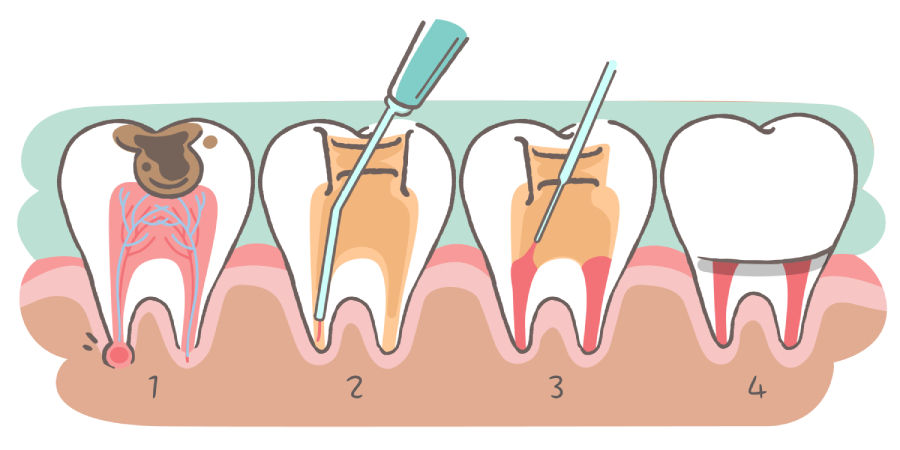 Illustration showing four steps of a root canal procedure: infected tooth, cleaning, filling, and final restored tooth.