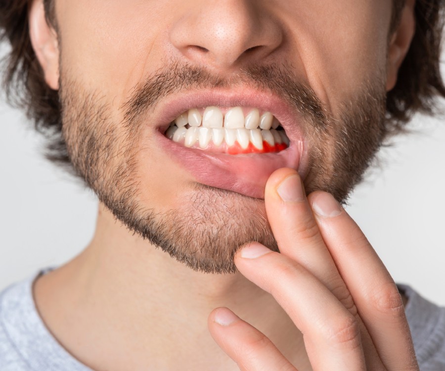A man pulling down his lower lip to show bleeding gums, indicating a possible dental or gum issue.