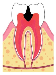 Cross-section illustration of a tooth showing a large cavity in the crown, extending into the dentin and pulp, surrounded by gum and bone tissue.