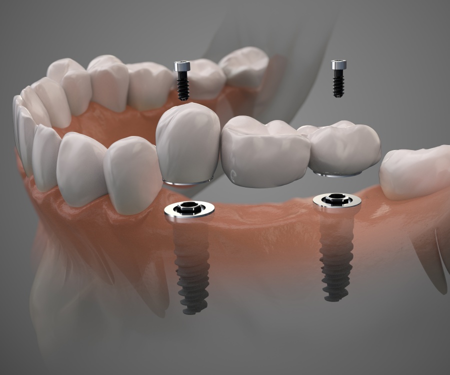 Digital illustration showing a dental implant procedure, with two implants being inserted into the jaw to support a bridge of artificial teeth.