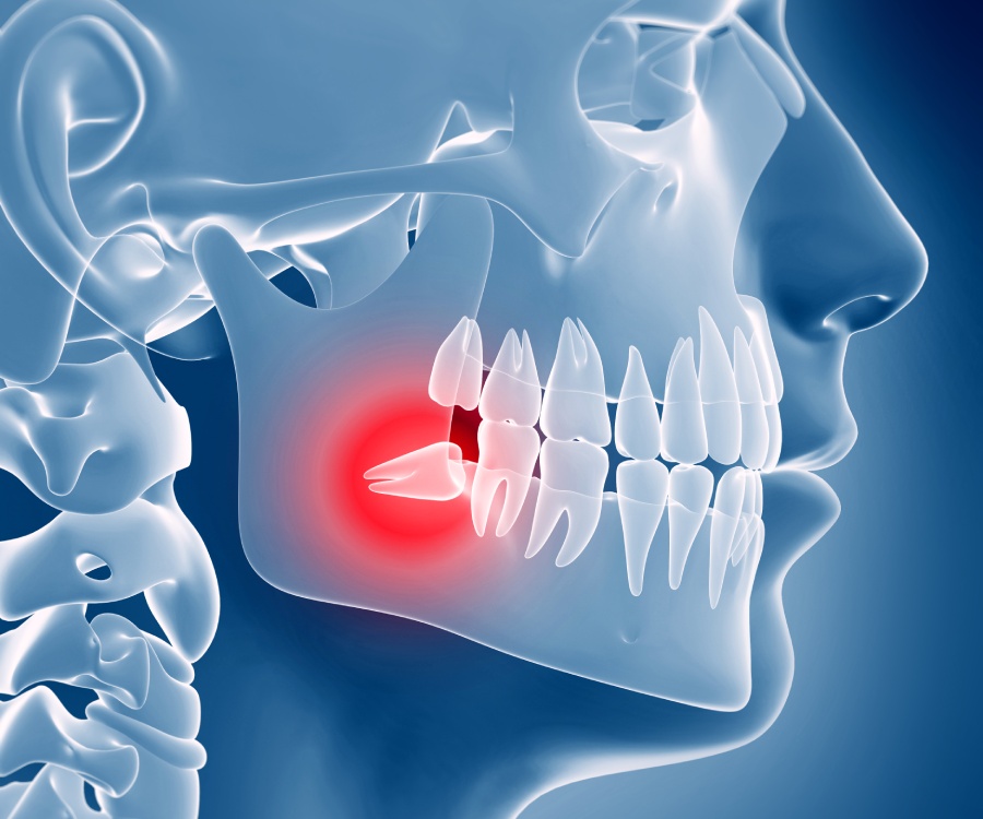 X-ray illustration of a human jaw highlighting an impacted wisdom tooth with a red glow, indicating pain or inflammation in the lower jaw.