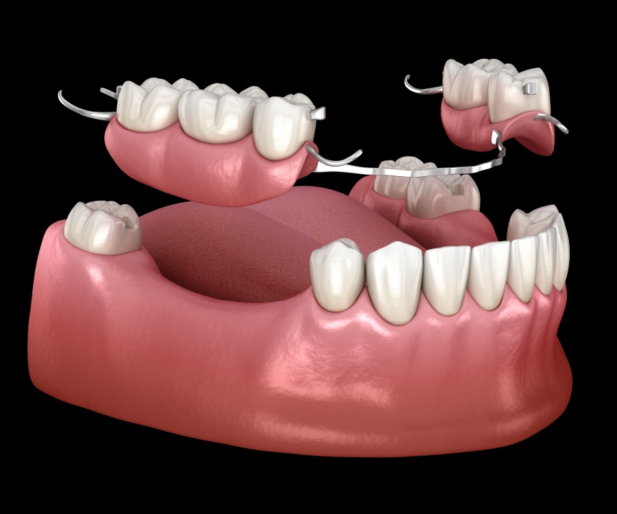 3D illustration of a lower jaw with partial dentures being fitted to replace missing teeth, showing gum, teeth, and metal clasps.