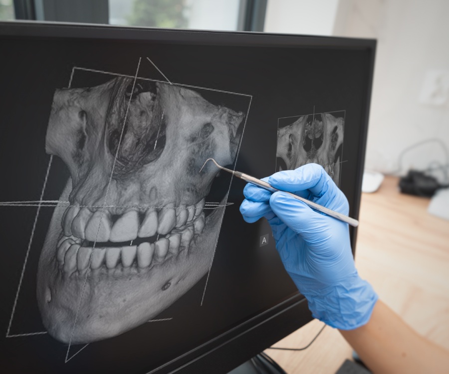 A gloved hand uses a dental tool to point at a 3D dental X-ray of an upper jaw displayed on a computer monitor.