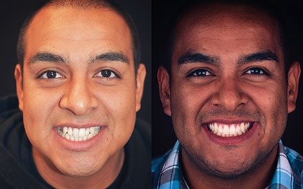 Two side-by-side portraits of a man smiling, showing his teeth; the left image shows a smoother complexion and the right image shows more facial texture and a checked shirt.