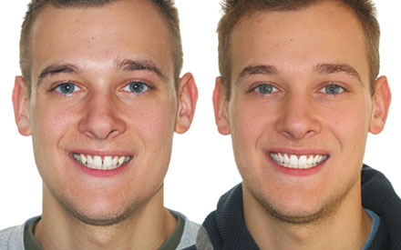 Side-by-side comparison of a young man before and after dental treatment, showing straighter and whiter teeth in the after photo.