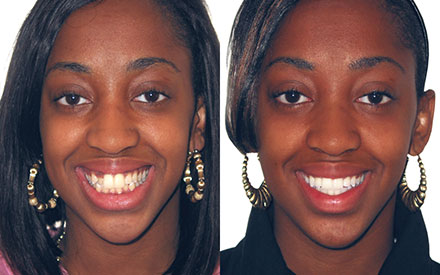 Side-by-side photos of a woman before and after dental treatment, showing an improvement in teeth alignment and smile.