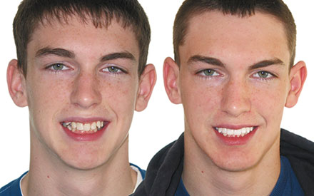 Two young men with short brown hair, one smiling with uneven teeth and the other smiling with straight teeth, are shown side by side against a white background.