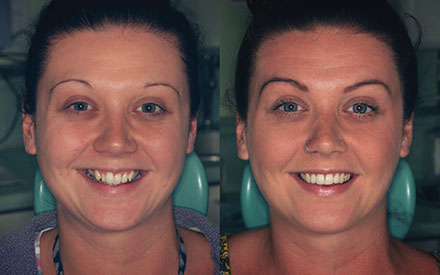 Side-by-side photos of a woman smiling, showing her teeth before dental treatment (left) and after dental treatment with improved, even teeth (right).