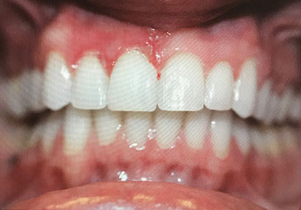 Close-up of a person's upper and lower teeth with slight redness on the gums above the upper front teeth.