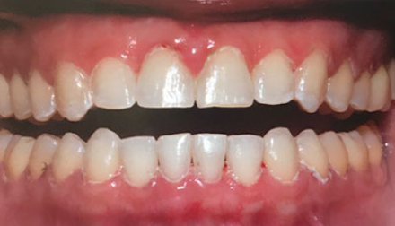 A close-up of a person's mouth with their teeth slightly apart, showing misaligned upper and lower teeth and visible gums.